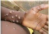 Monkeypox: NCDC confirms 157 cases in Nigeria