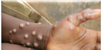 Monkeypox: NCDC confirms 157 cases in Nigeria